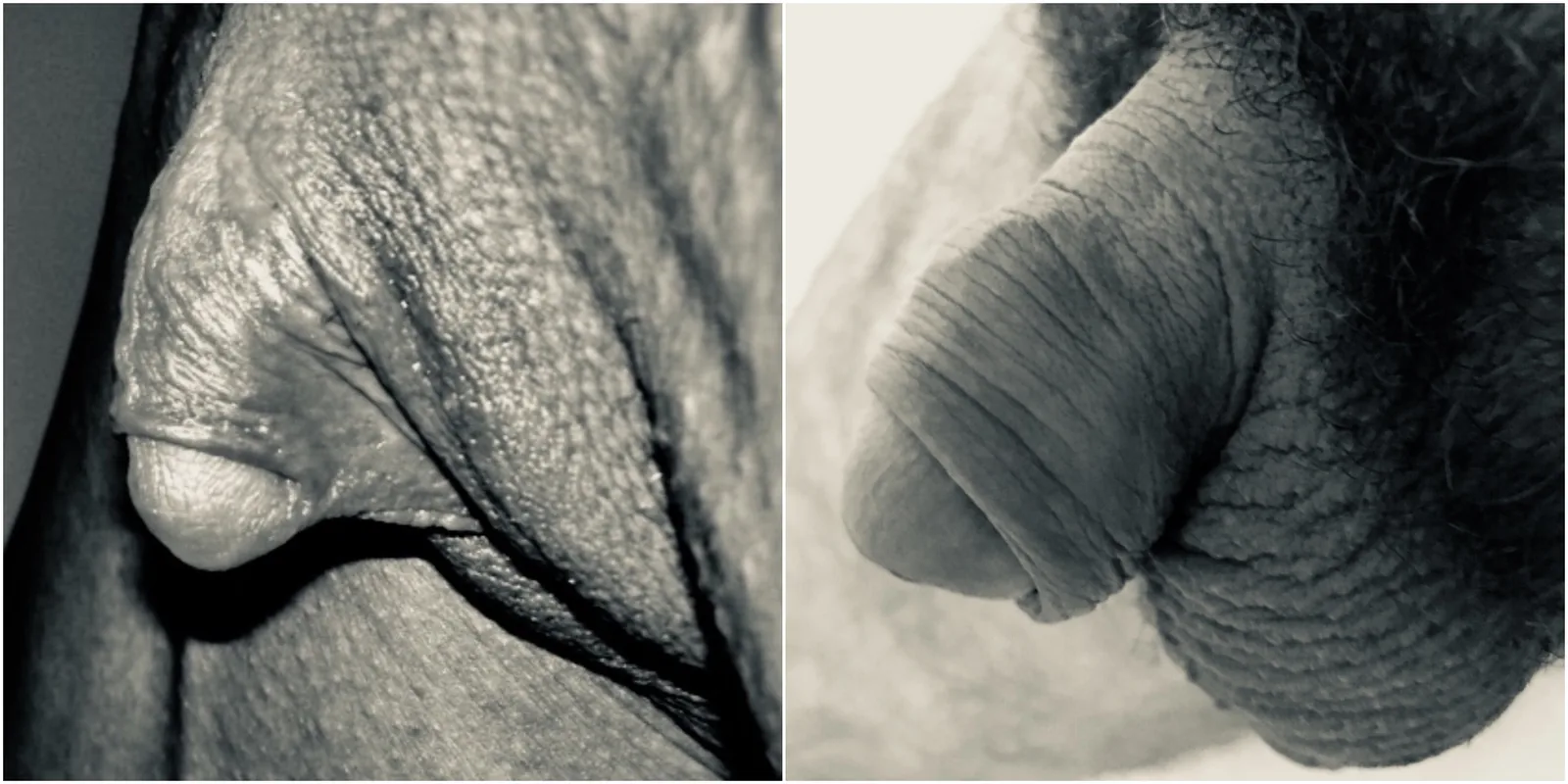 Comparaison anatomique entre clitoromégalie et pénis - schéma médical