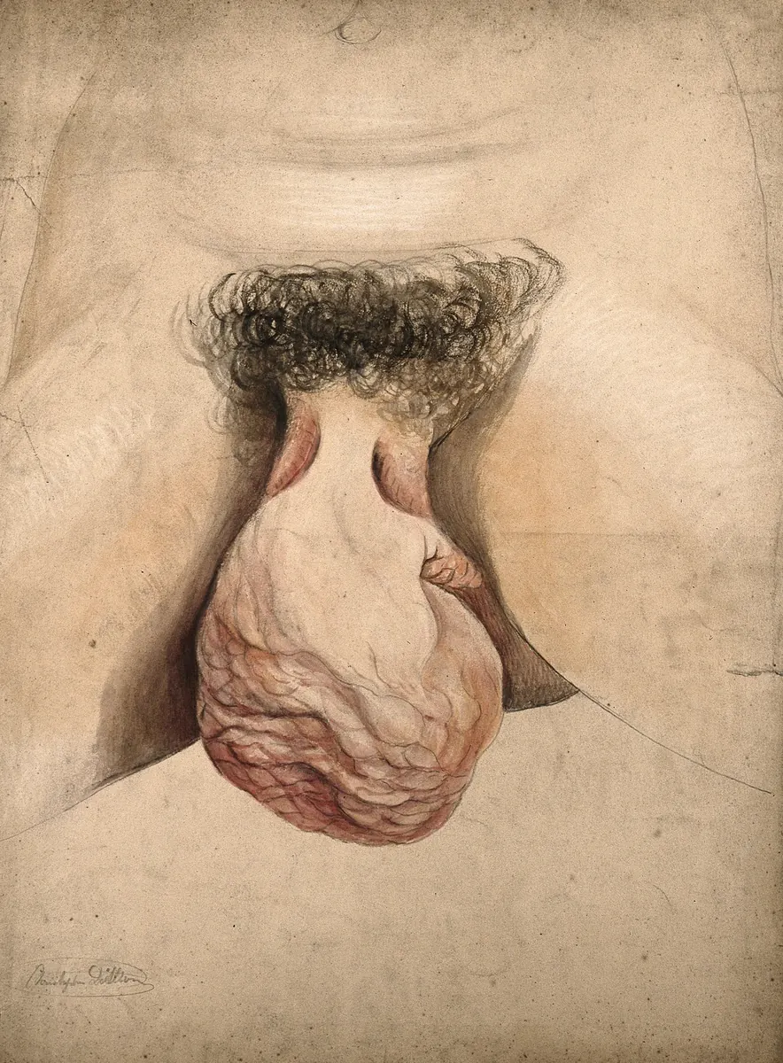 Illustration médicale historique d'hypertrophie clitoridienne par Christopher D'Alton, 1857